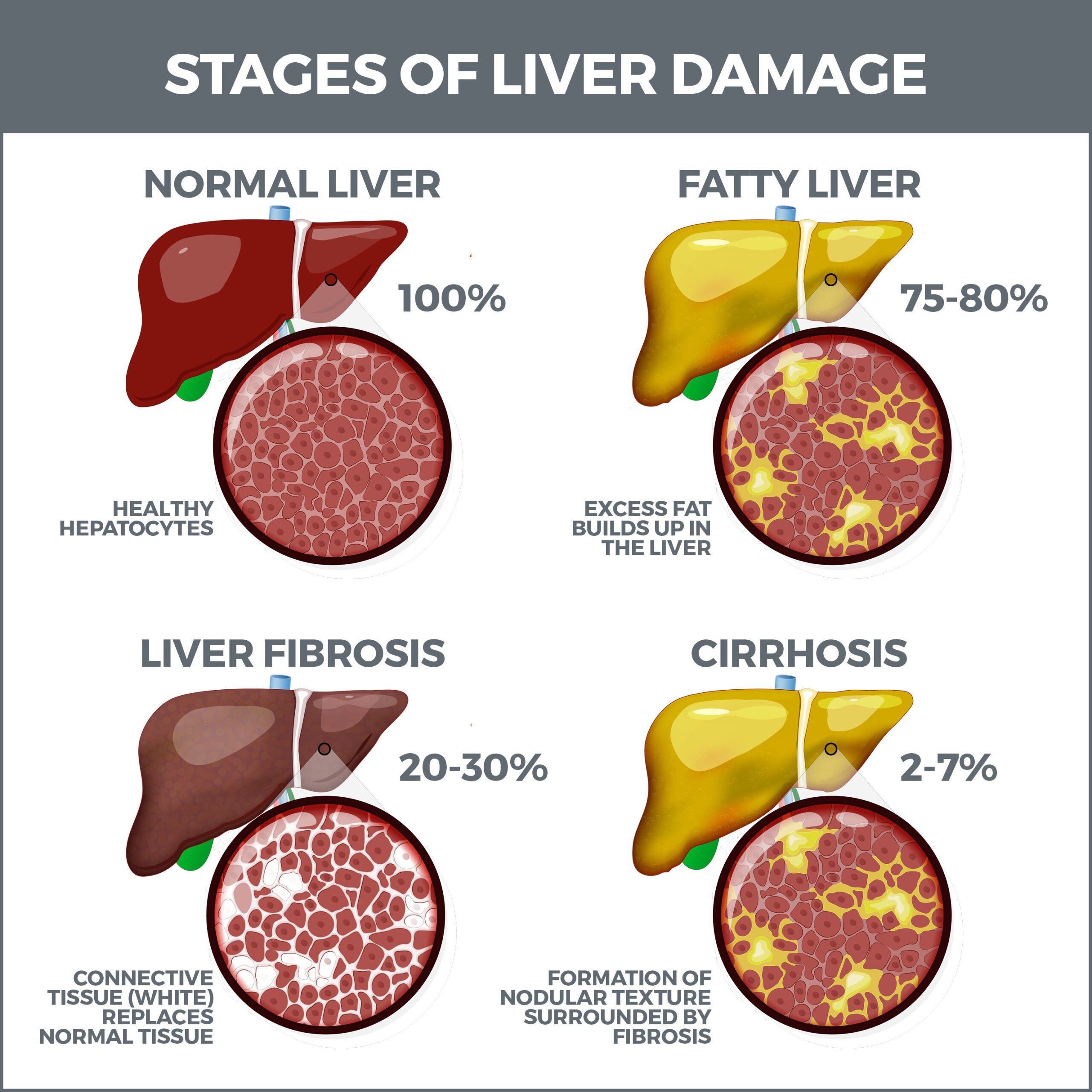 Cirrhosis | Gastro MD