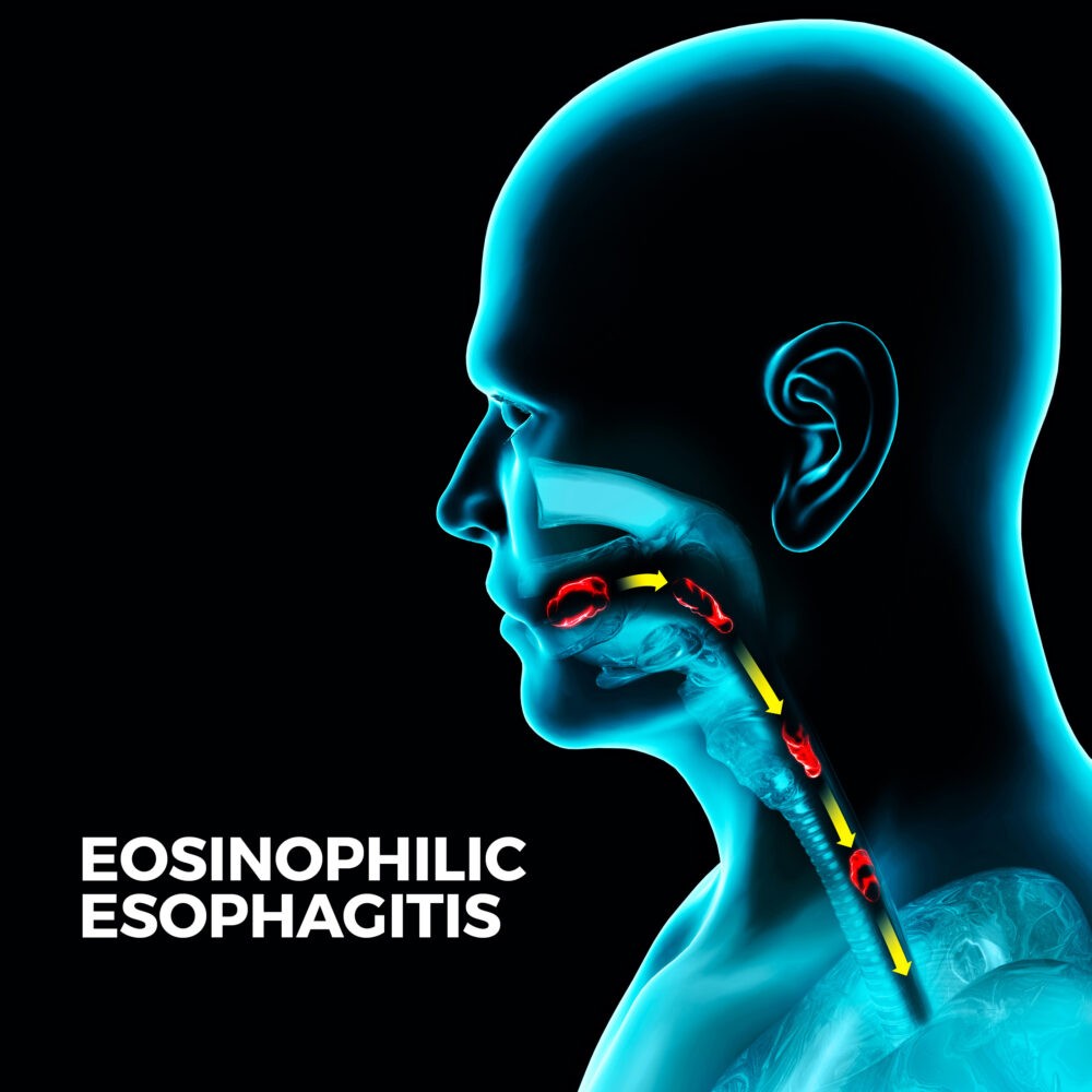 Eosinophilic Esophagitis Gastro Md 8621