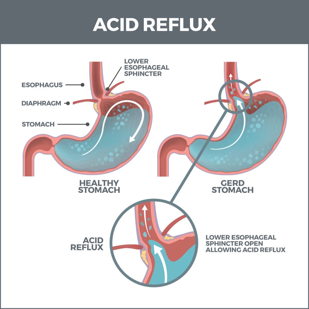 Gastroesophageal Reflux Disease (GERD) Gastro MD