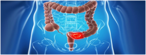 Colonoscopy-screening-for-colon-cancer.-when-should-you-get-checked-1