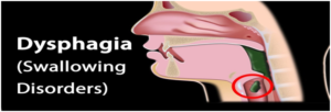Having-difficulties-with-swallowing-food-getting-caught-dyshpagia-choking-1