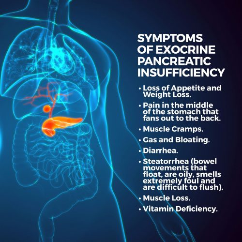 Exocrine Pancreatic Insufficiency | Gastro MD