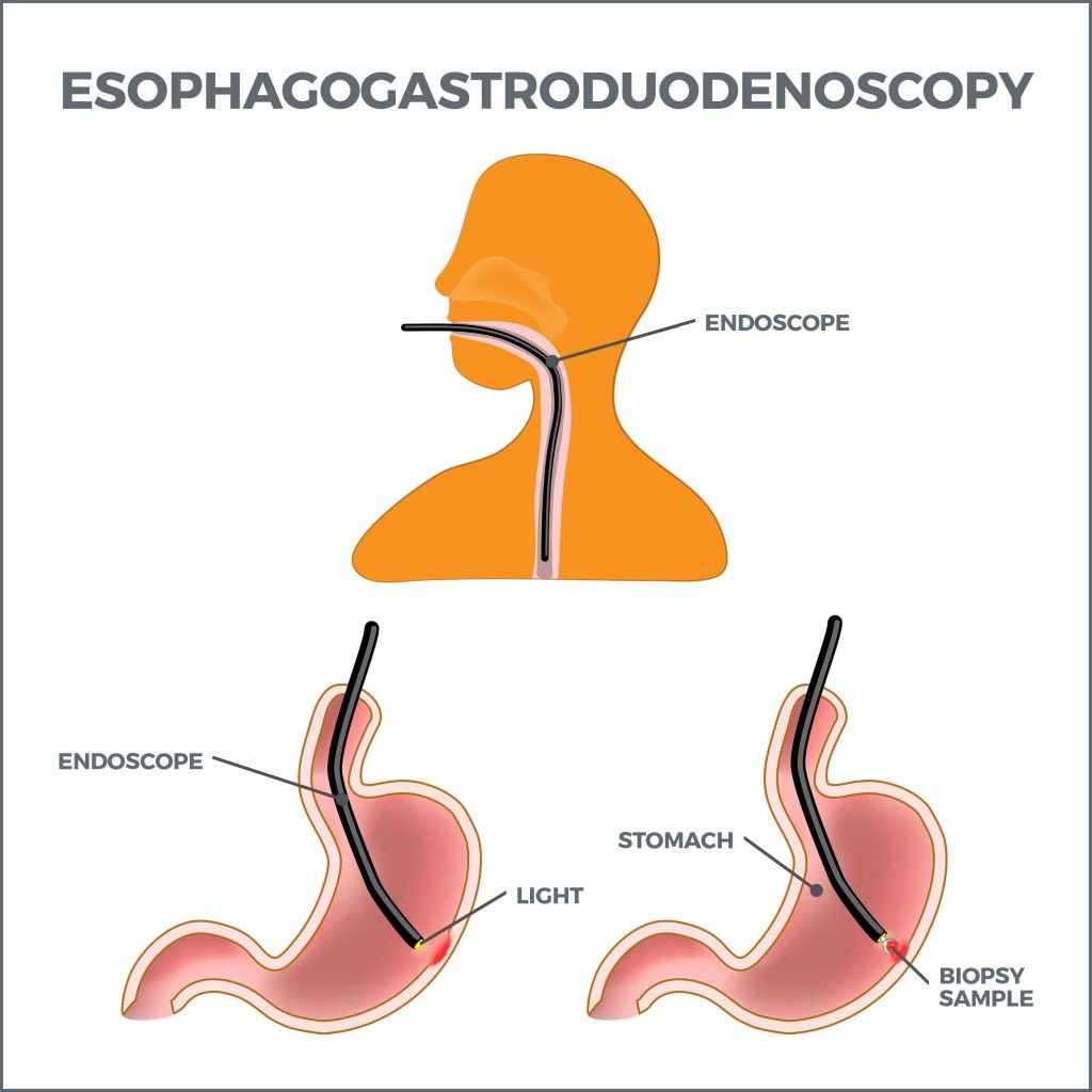 Upper GI Endoscopy Gastro MD