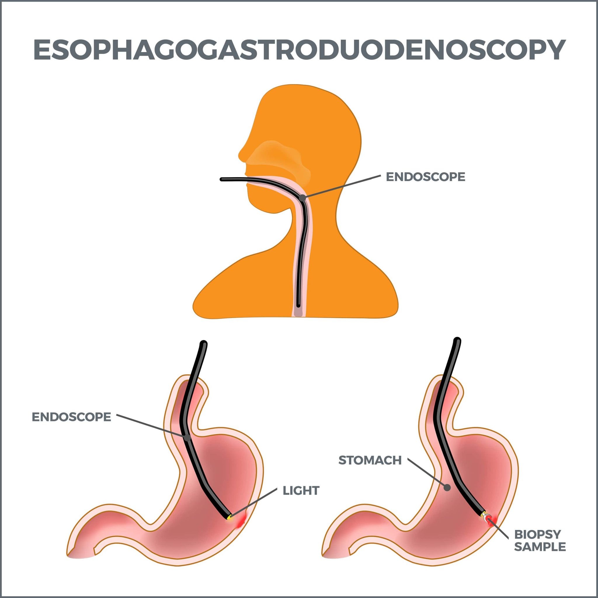 How Long Does It Take To Get Endoscopy Results at Virginia Langley blog