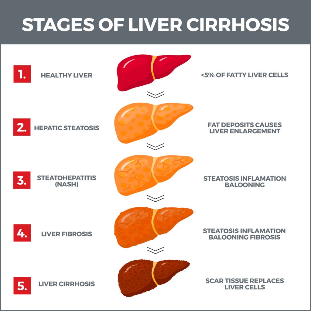 General Liver Conditions | Gastro MD