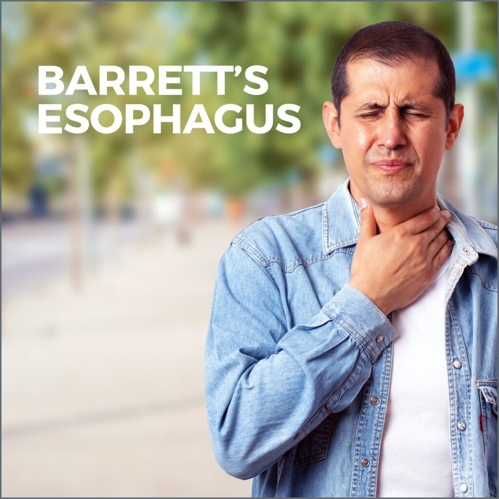 Barrett’s Esophagus Gastro MD