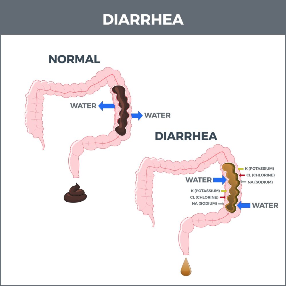 Diarrhea | Gastro MD