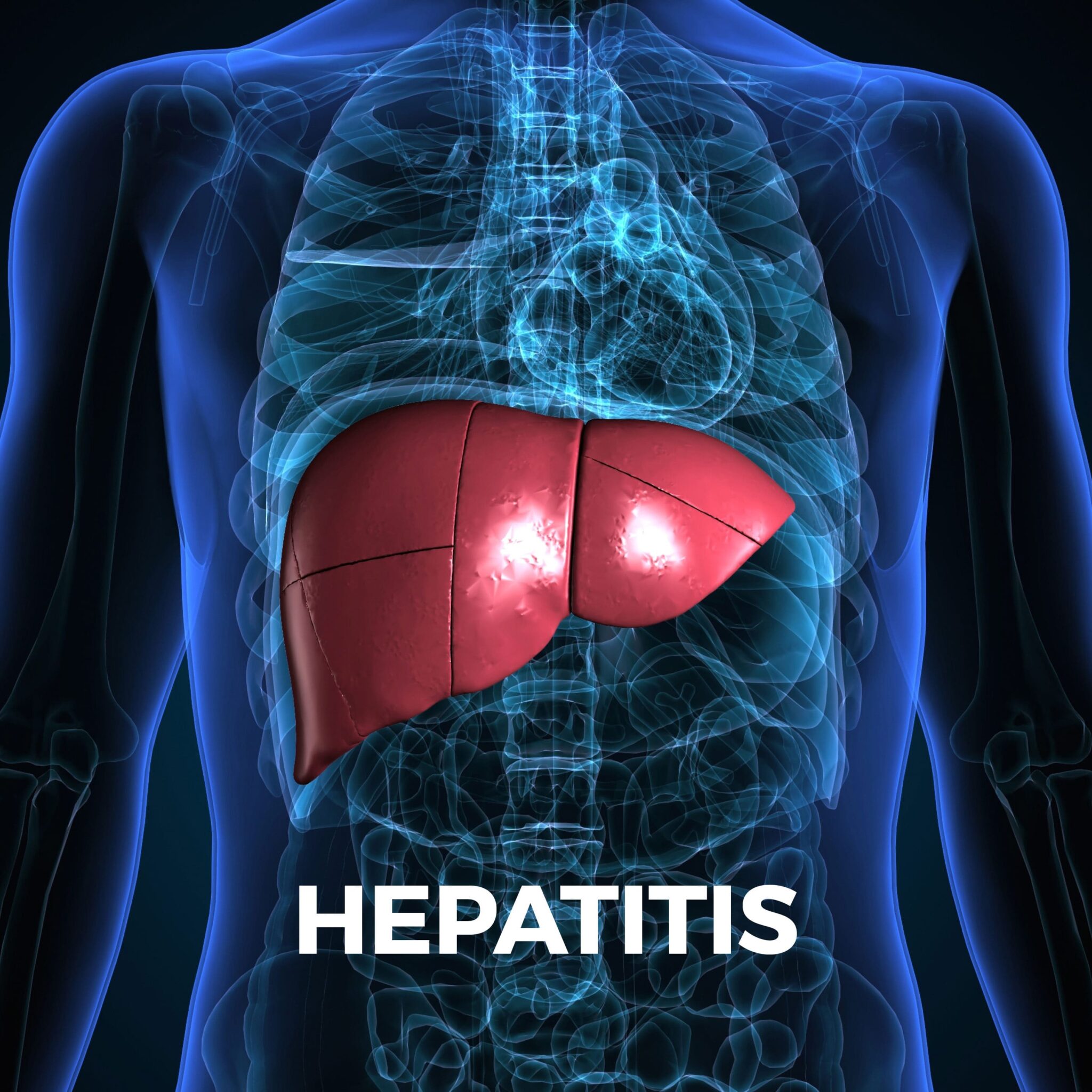 Hepatitis Overview Gastro Md 6499