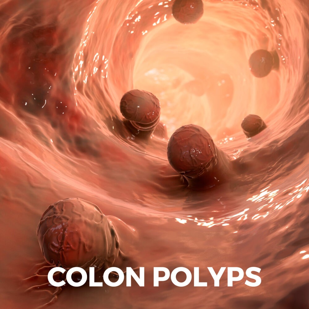 Colon Polyps Gastro MD   Colon Polyps 1000x1000 