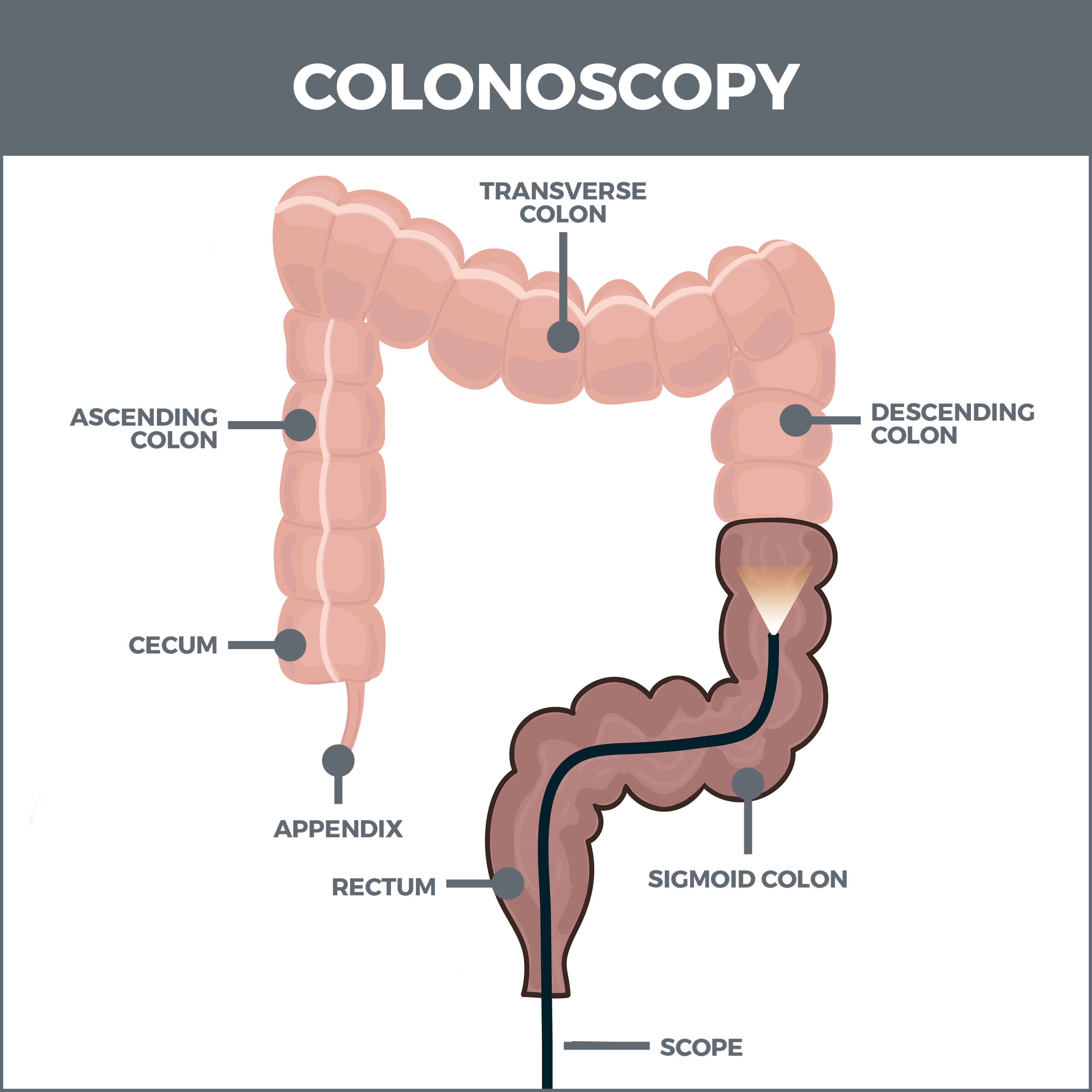 Colonoscopy Gastro MD