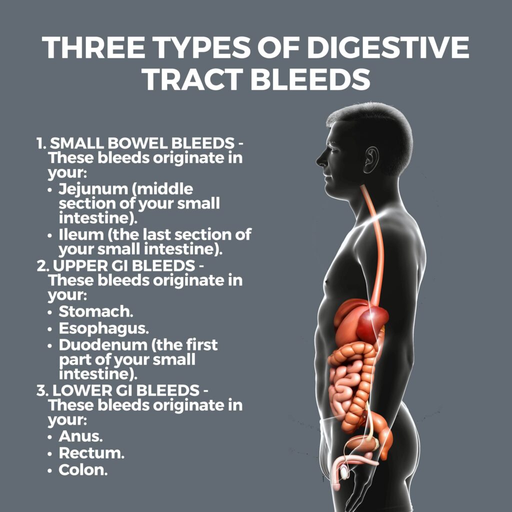 Bleeding In The Digestive Tract Gastro Md