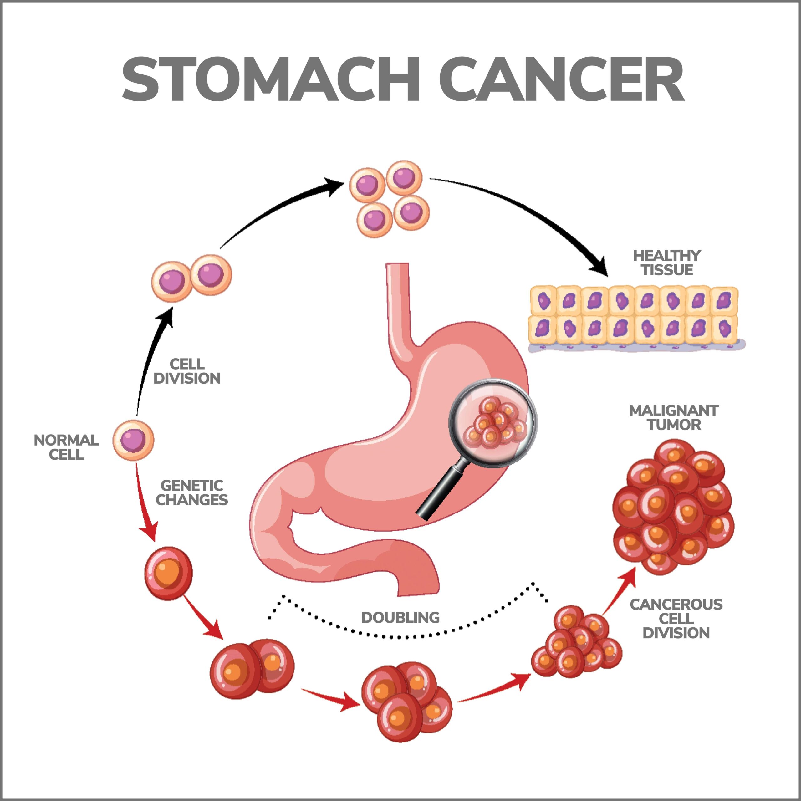 Understanding the Progression of Stomach Cancer: How Fast Does it Spread?