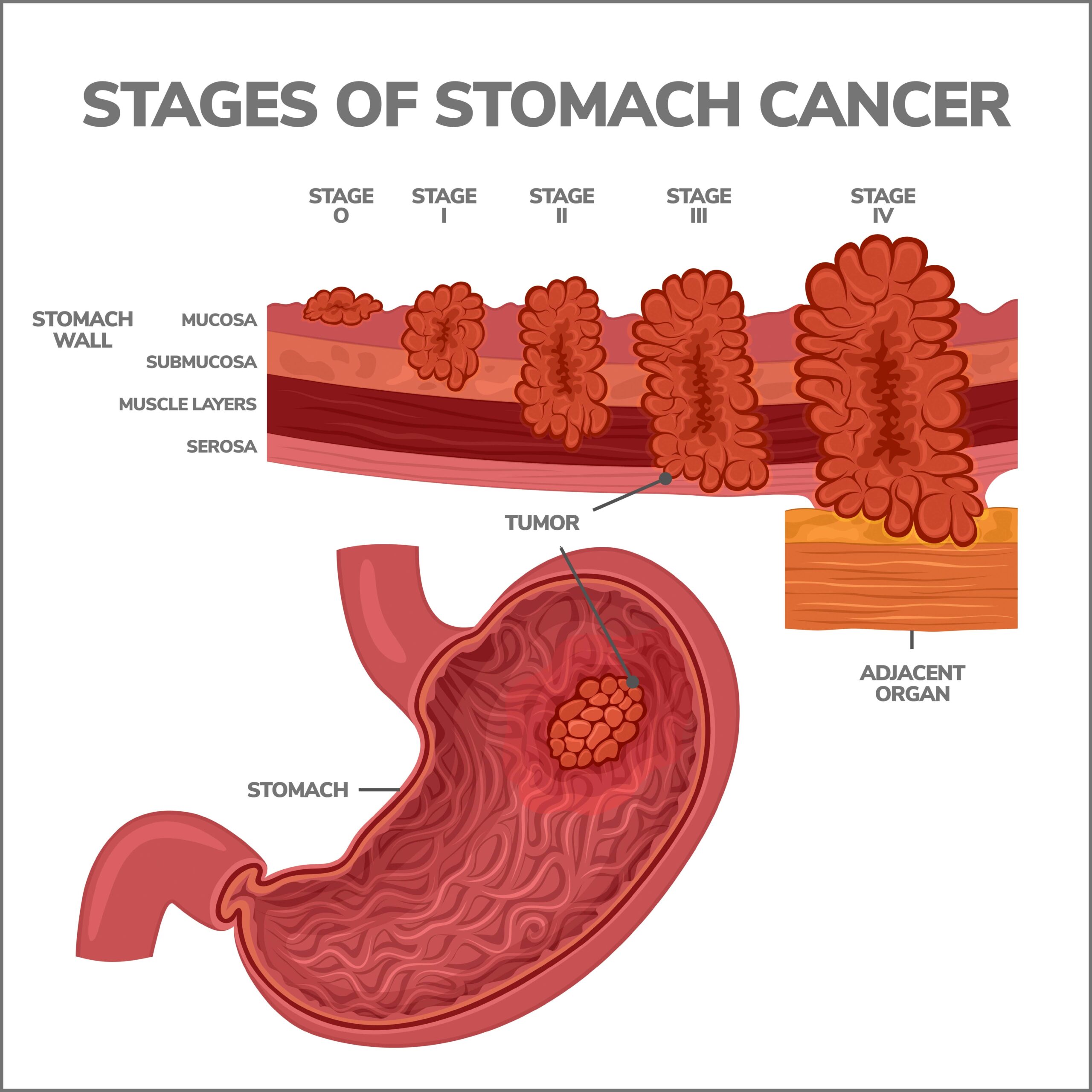 Understanding the Progression of Stomach Cancer: How Fast Does it Spread?
